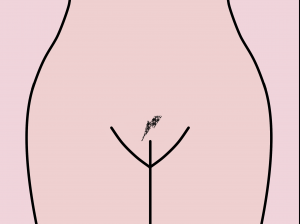 Pubic hair in a lightning bolt style Pubic hair in a lightning bolt style